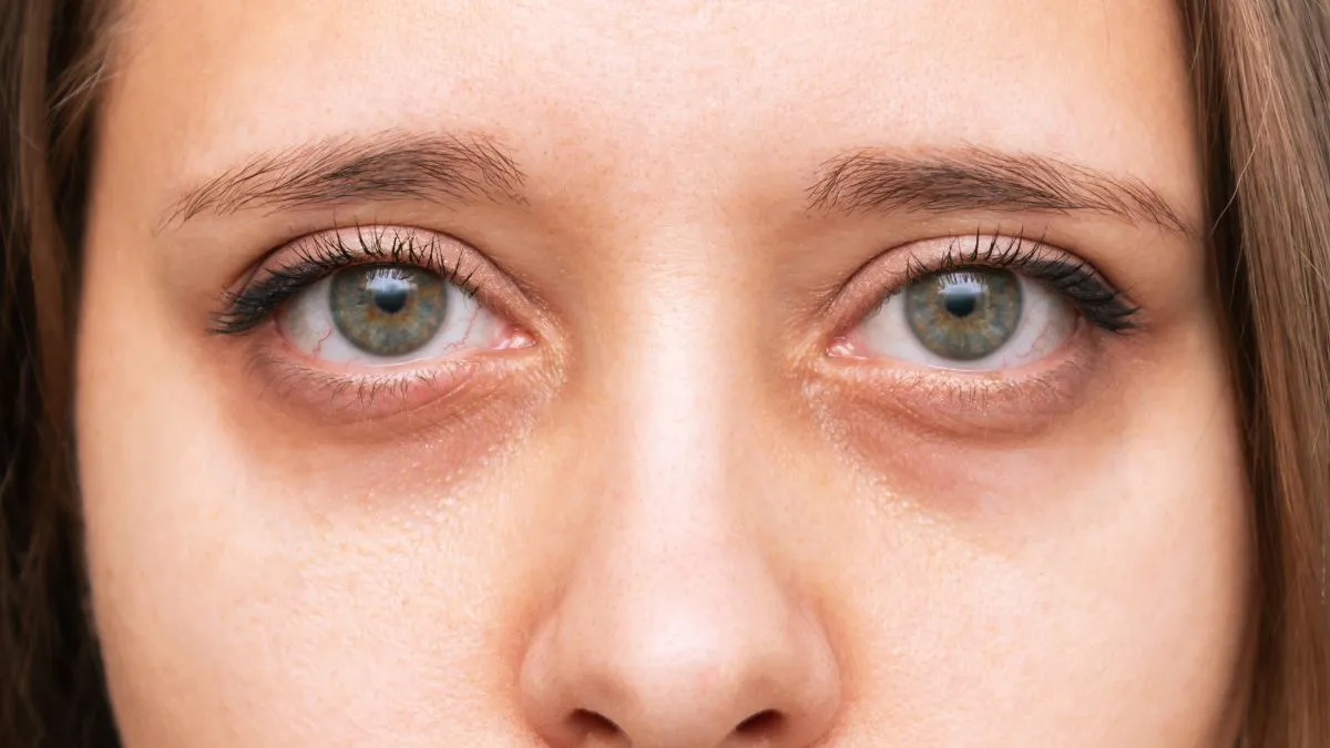 5-quick-fixes-to-banish-dark-circles-in-under-7-days