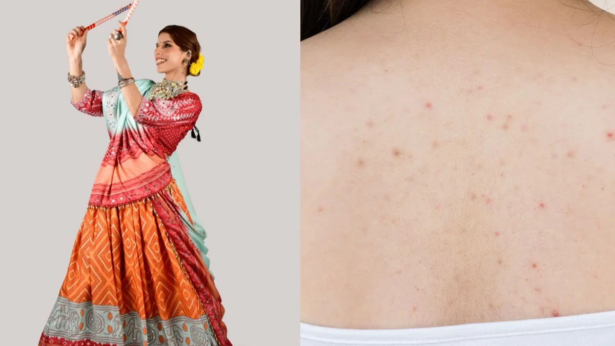 how-to-get-rid-of-back-acne-before-garba-try-these-5-diy-ways-ahead-of-wearing-lehenga-choli