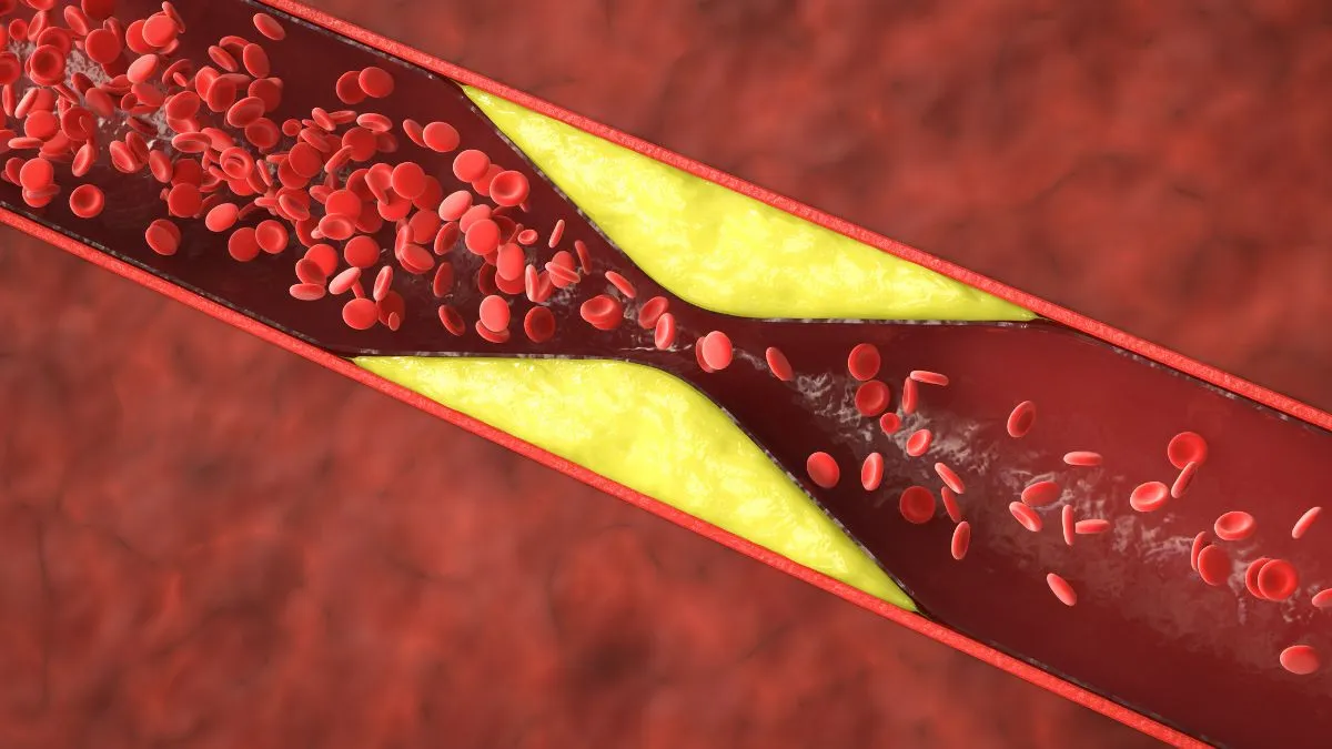 plaque-buildup-in-your-arteries-doctor-explains-it-could-be-cad