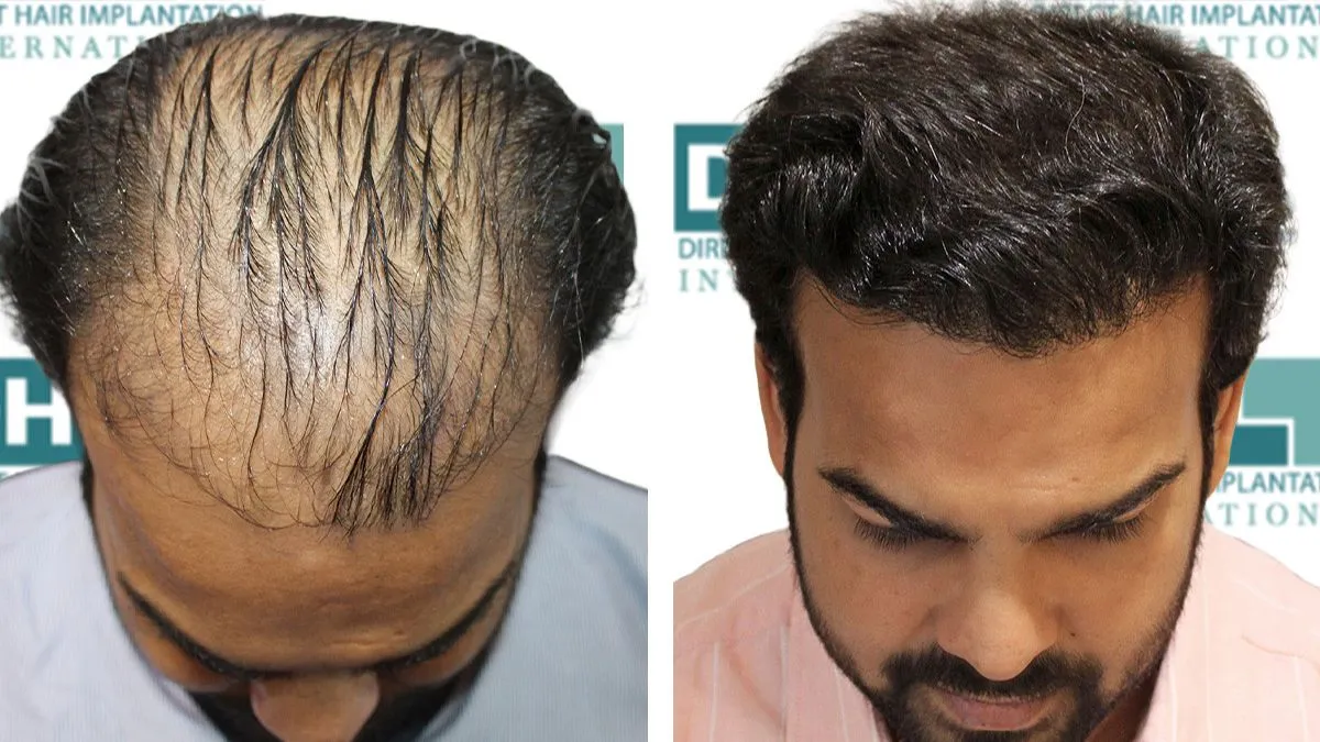 quality-concerns-plague-india-hair-transplant-industry-amid-unqualified-practitioners