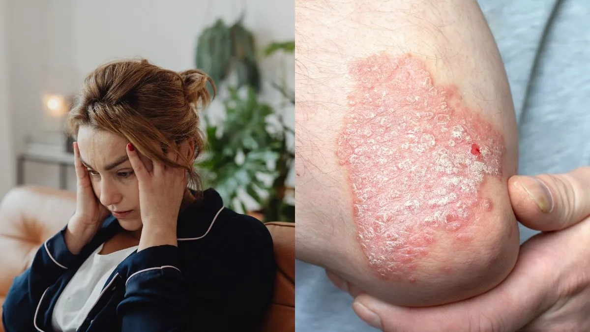 world-psoriasis-day-2025-doctor-explains-how-stress-triggers-psoriasis-flare-ups