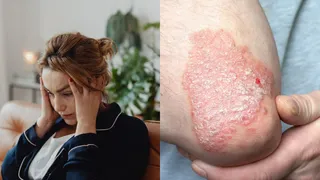 World Psoriasis Day 2025: Doctor Explains How Stress Triggers Psoriasis Flare-Ups