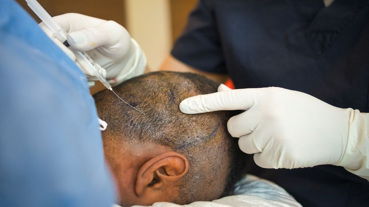 Hair Transplant Industry