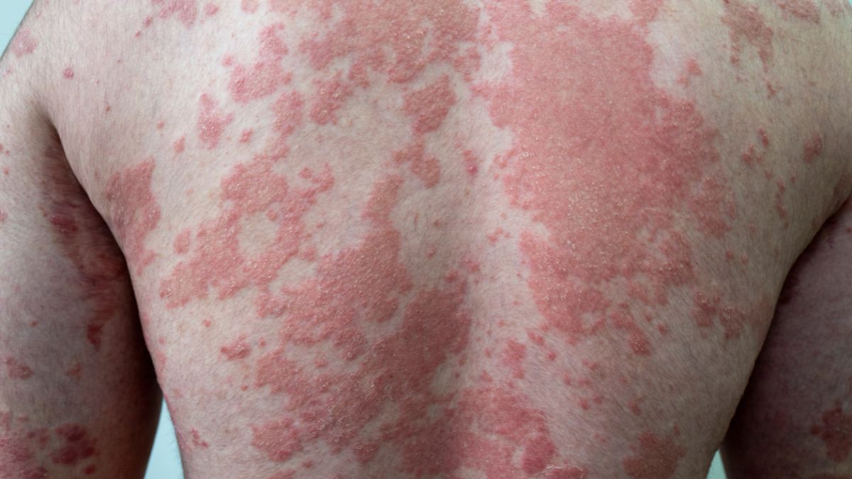 Psoriasis