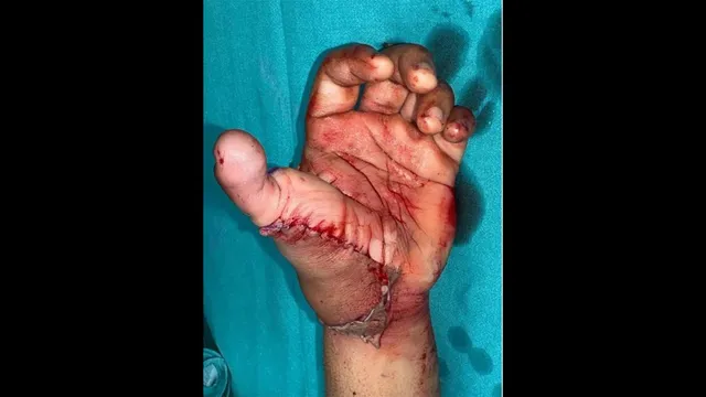delhi-doctors-reconstruct-mans-thumb-using-toe-from-amputated-leg-after-road-accident
