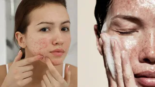 Changing Weather Causing Acne? 5 Skincare Hacks Your Skin Needs This Season For Acne-Free Glow