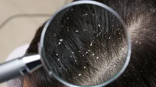 5 Dandruff Myths You Need To Stop Believing Right Away
