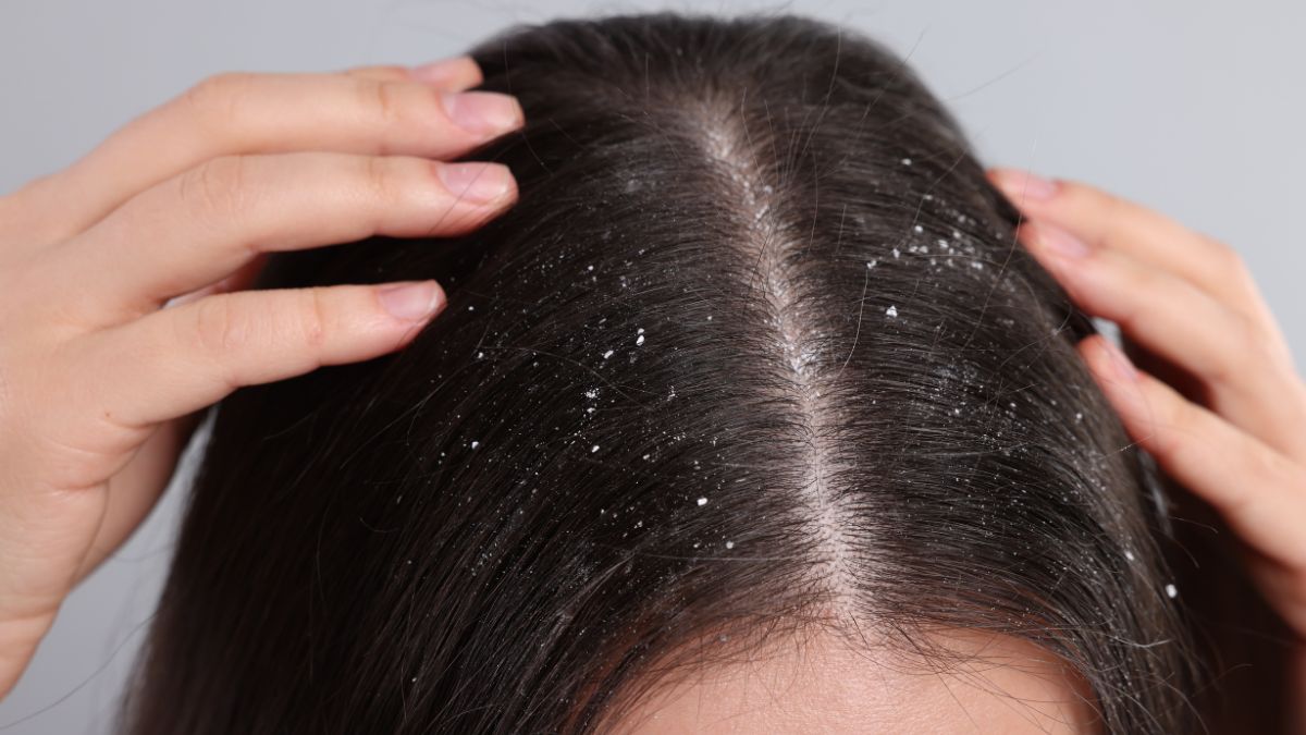 Dandruff Myths Busted
