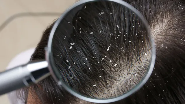 how-to-remove-dandruff-fast-natural-home-remedies-to-remove-flakes-from-scalp