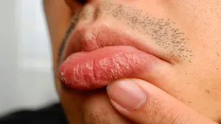 Dry, Chapped Lips No More: Get Soft, Supple Lips In 3 Days With These 7 Tips
