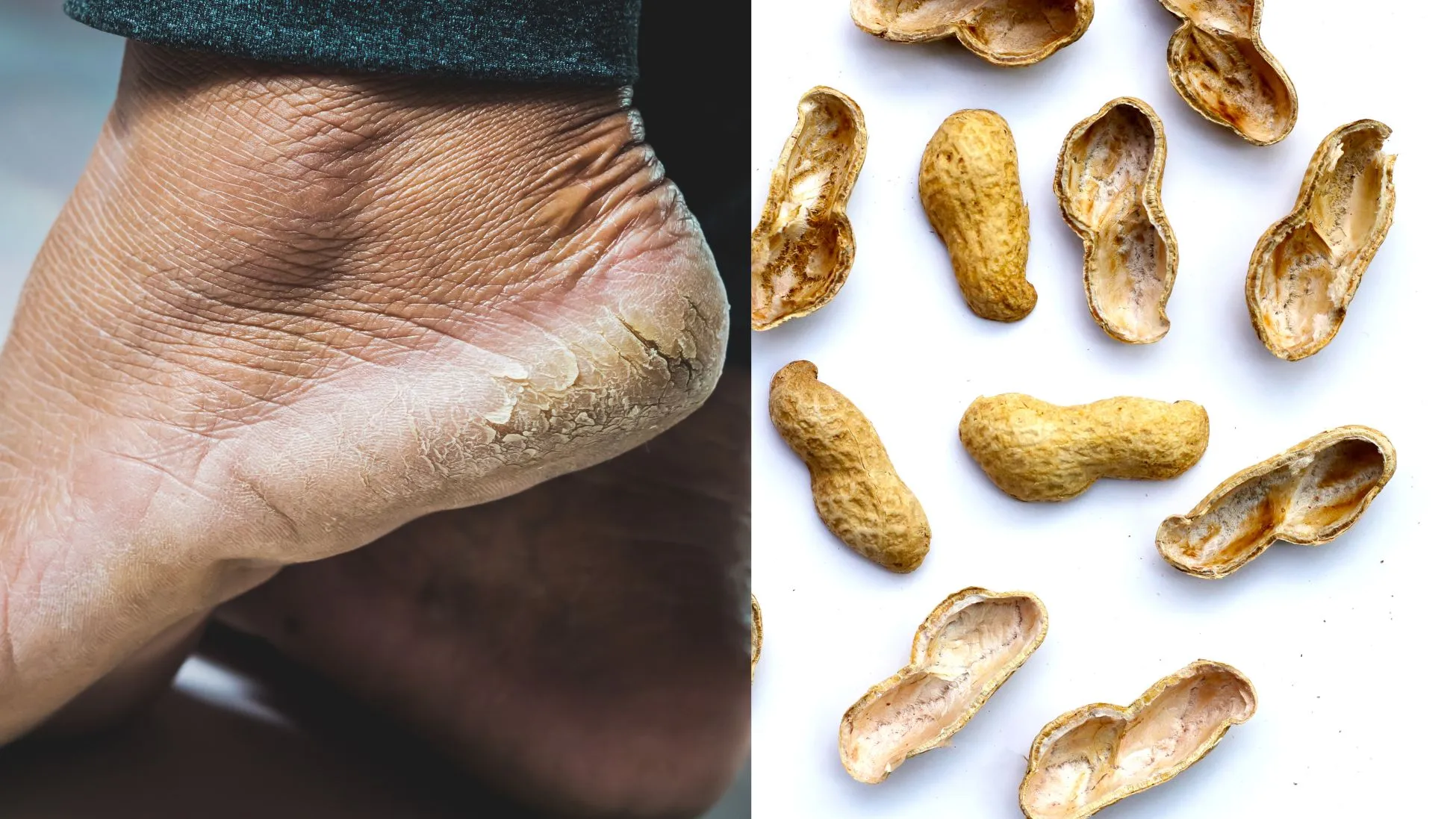 Peanut Shells For Cracked Heels? Try This DIY Heel Hack That Actually ...