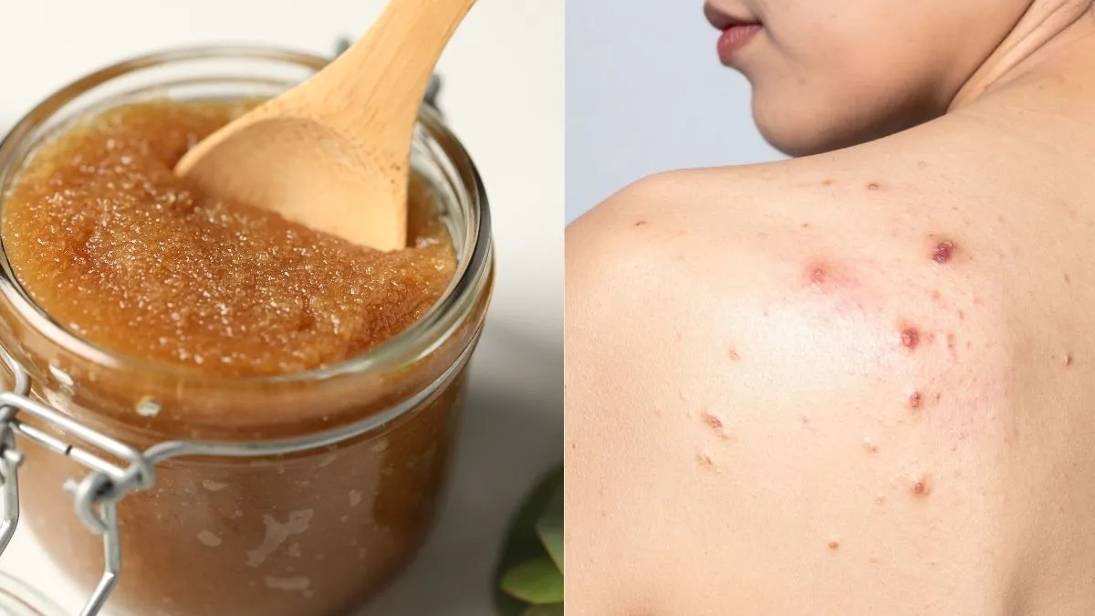 Natural Homemade Remedies For Body Acne: These 5 DIY Body Scrubs To ...