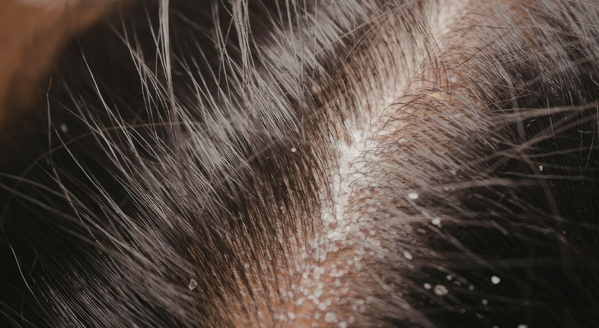 dry scalp