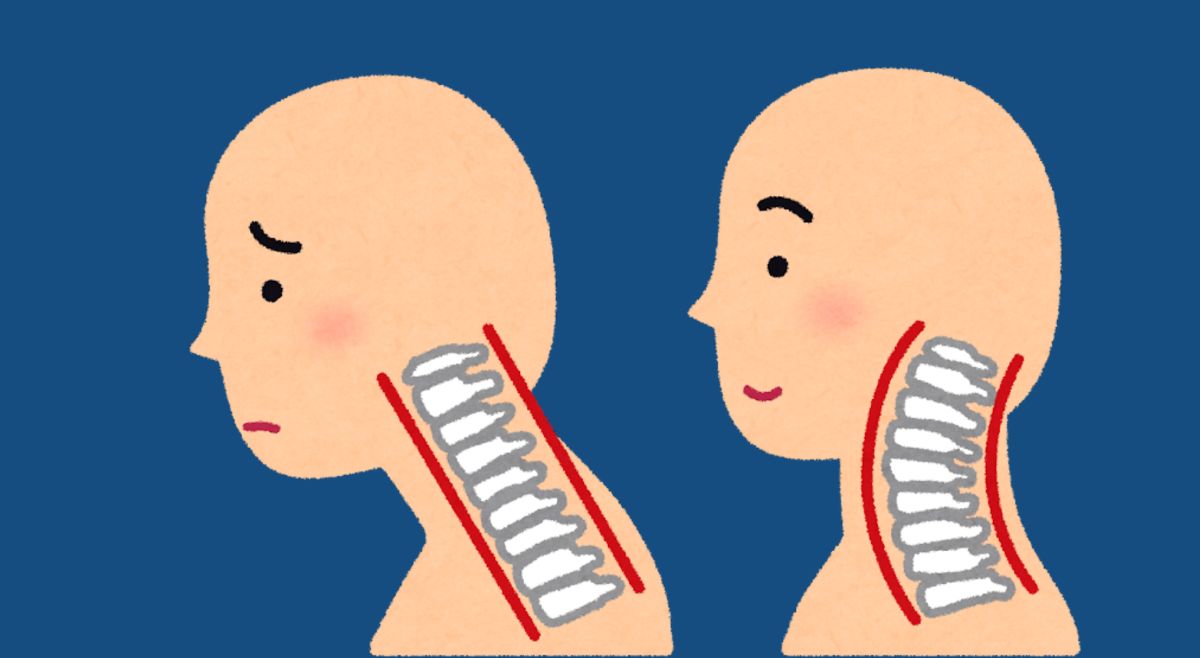 text neck symptoms