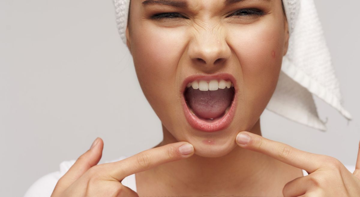 Chin Pimples