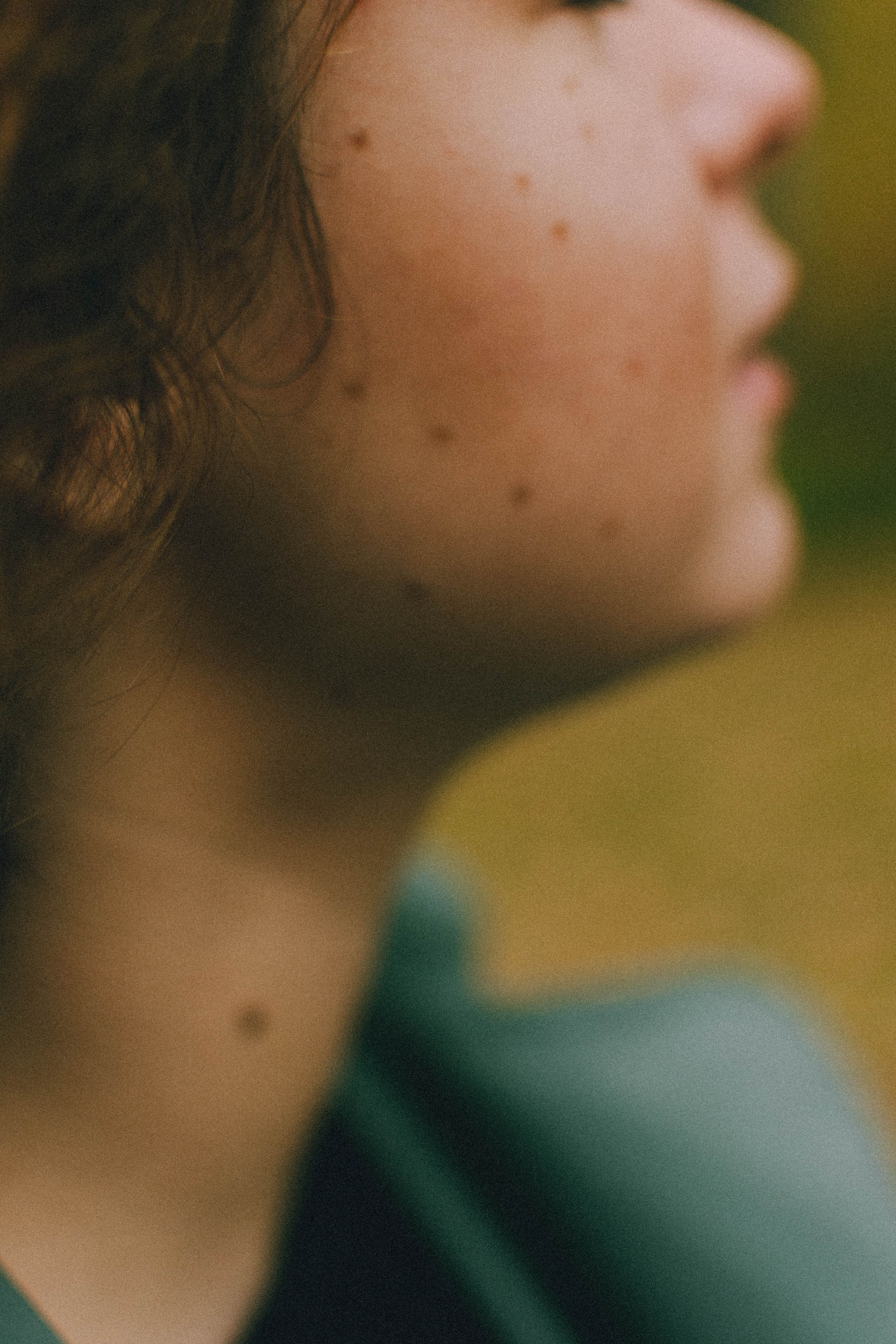 mole on the cheek
