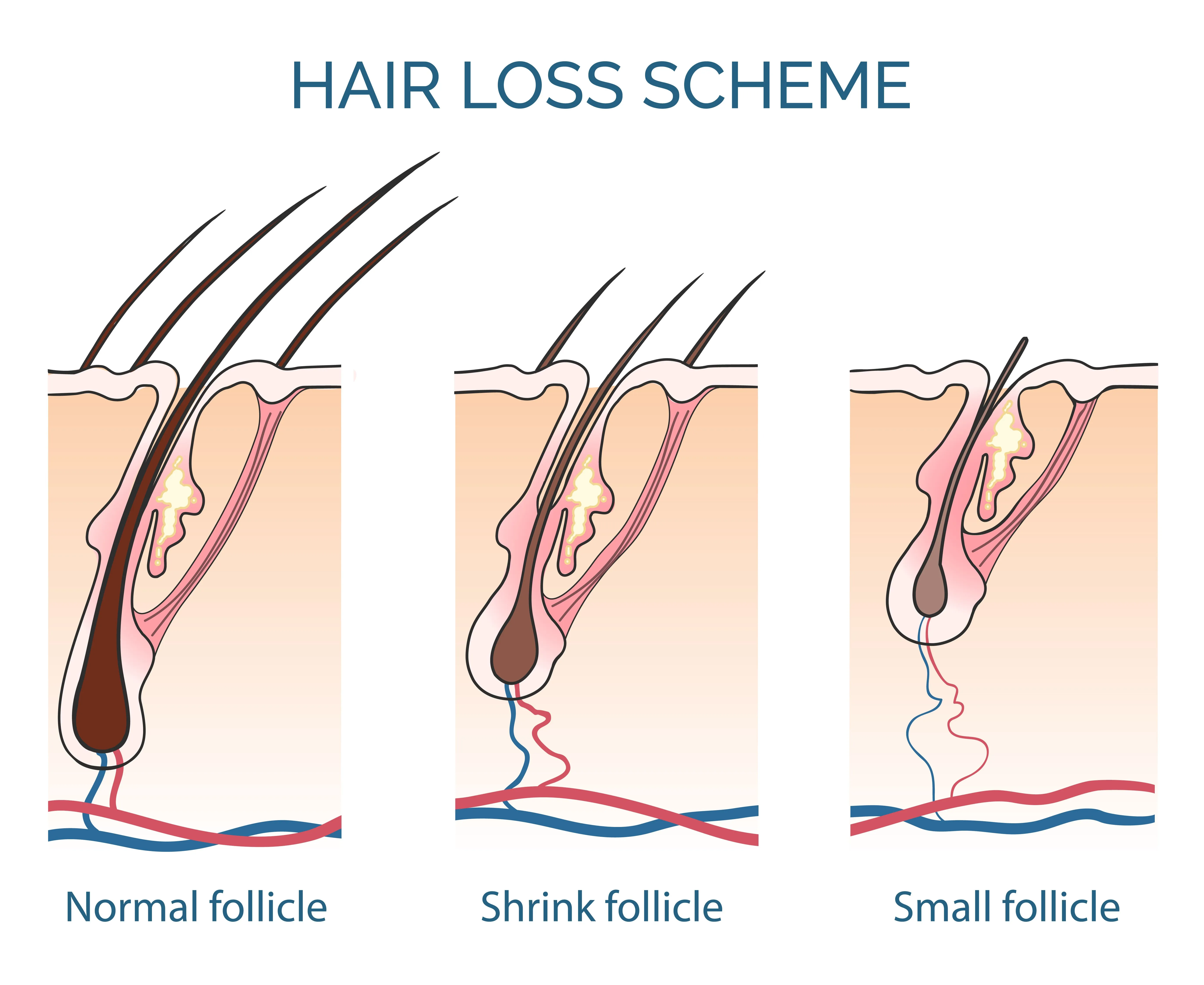 hair loss scheme