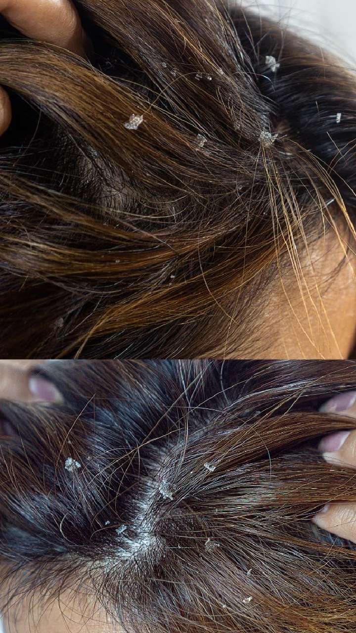 How to Get Rid of Dandruff  Tips and Remedies  Your Comprehensive Guide