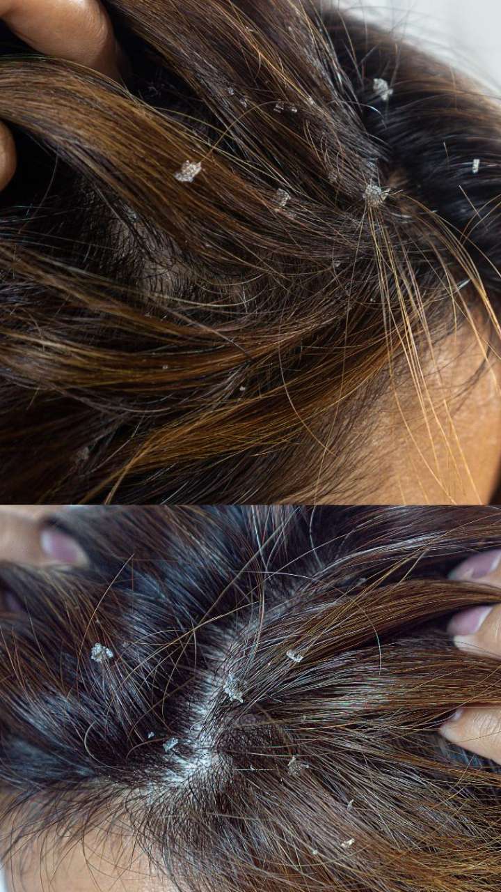 Natural Ways To Remove Dandruff From Your Hair