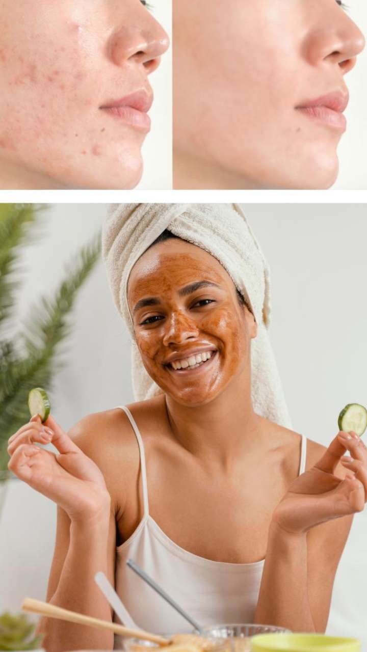 Top Natural Homemade Face Masks To Remove Acne Natural Skincare Tips