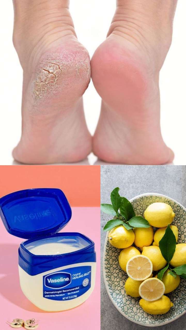 20-easy-home-remedies-for-cracked-heels-that-work-styles-at-life