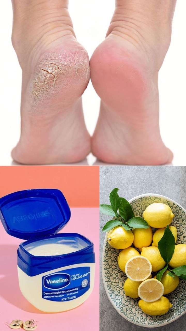 Try These Home Remedies And Say Goodbye to Cracked Heels - News18-hkpdtq2012.edu.vn