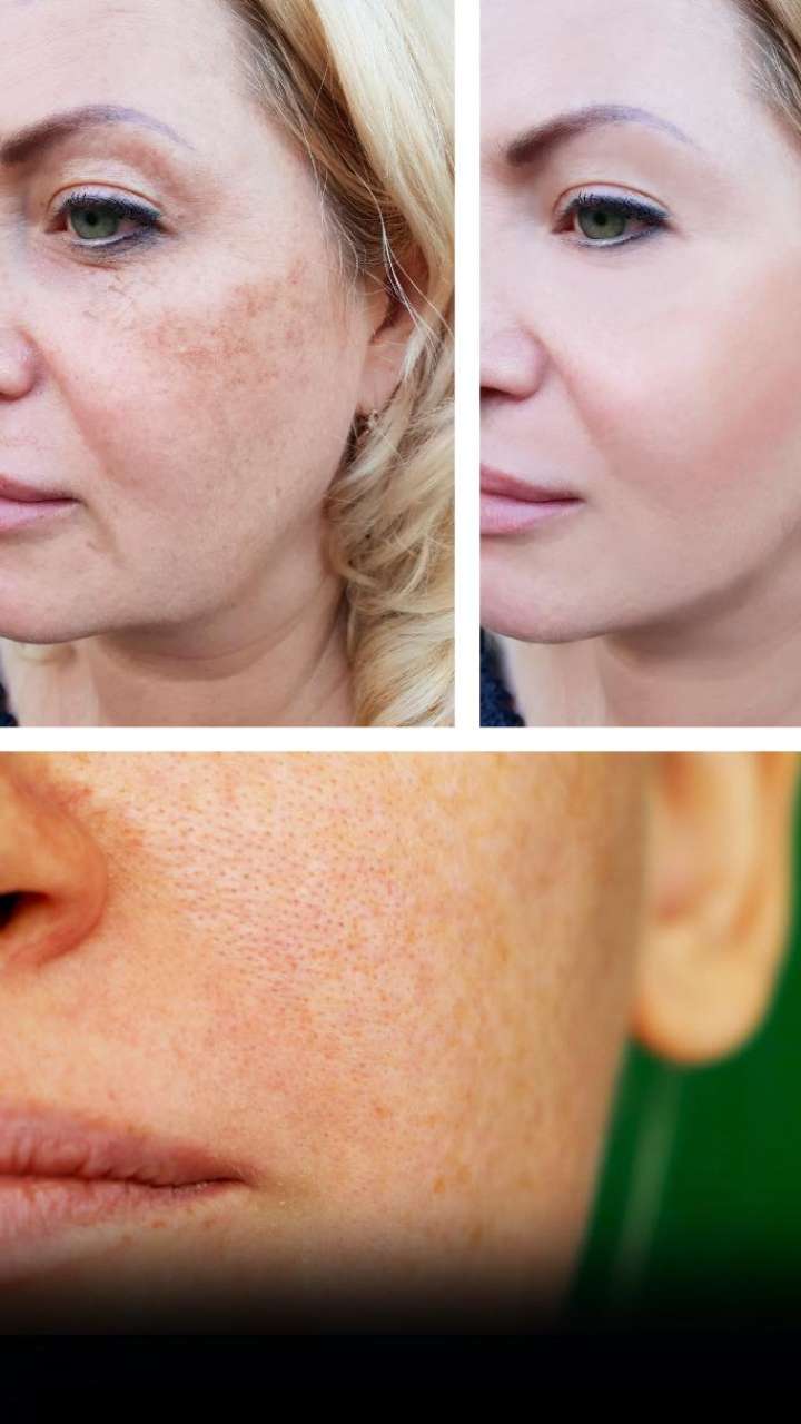 best-natural-remedies-to-remove-pigmentation