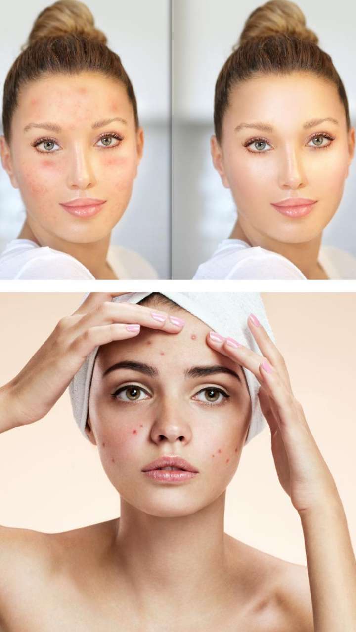 effective-home-remedies-to-remove-acne-marks-from-face-natural