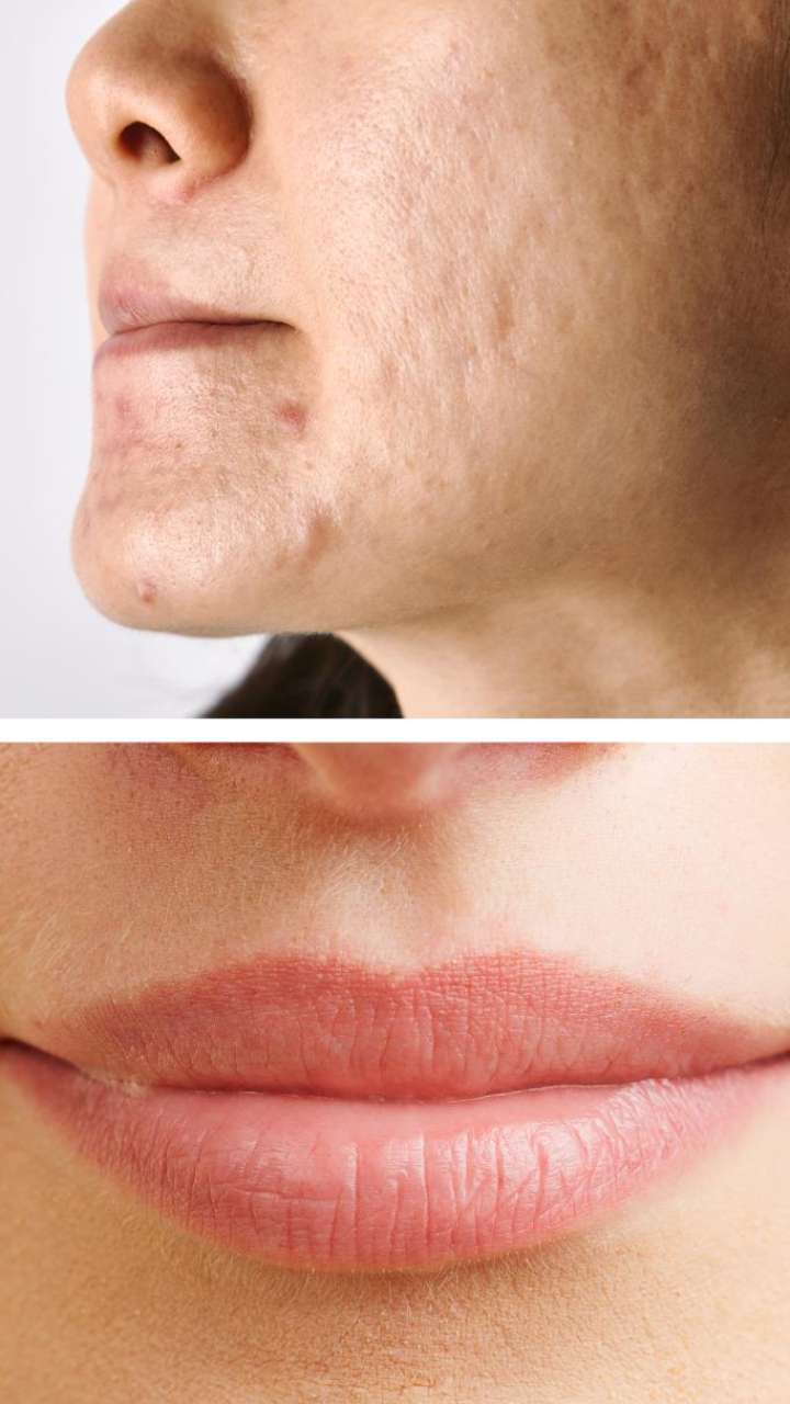 best-home-remedies-to-remove-pigmentation-around-mouth-natural