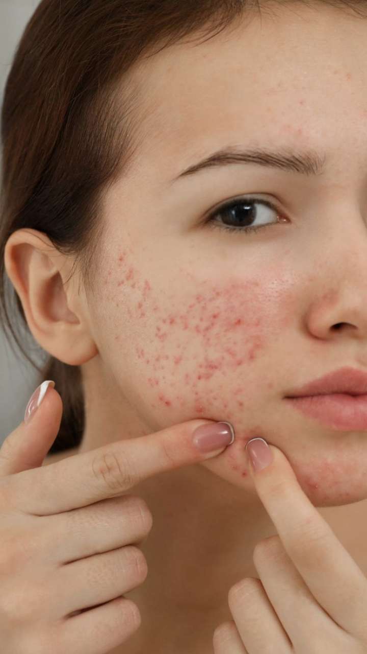 7 Simple And Effective Tips To Avoid Acne Breakouts